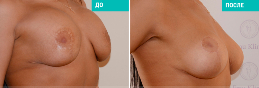 Повторная пластика груди