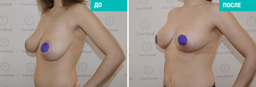 Мастопексия