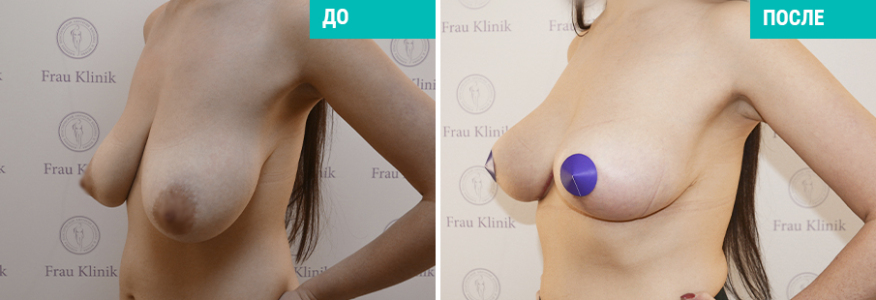 Мастопексия