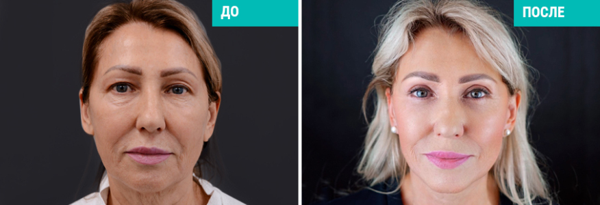 Deep-Smass подтяжка