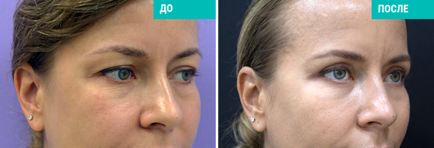 Верхняя блефаропластика