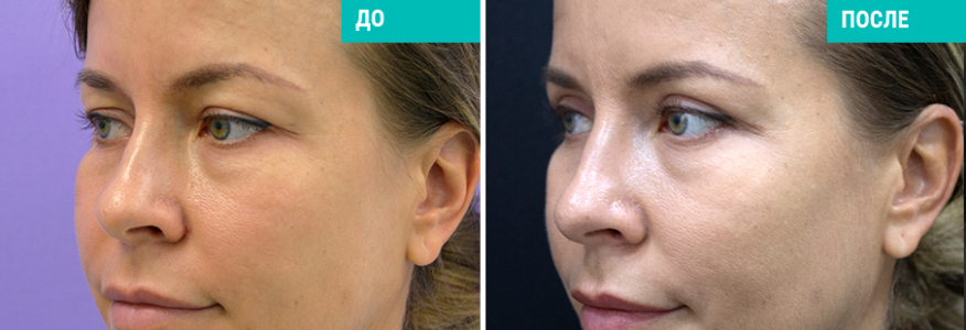 Верхняя блефаропластика