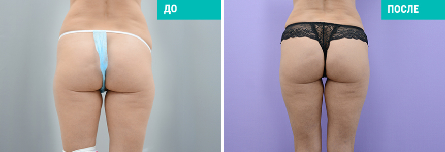 Липосакция