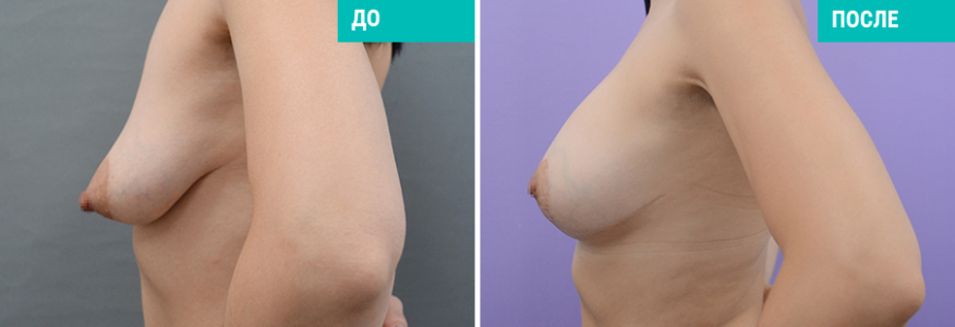 Подтяжка груди