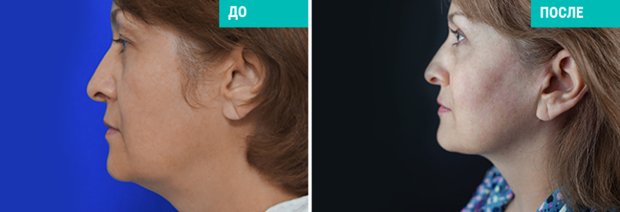 Фейслифтинг