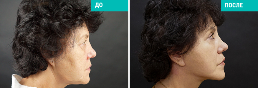 Фейслифтинг