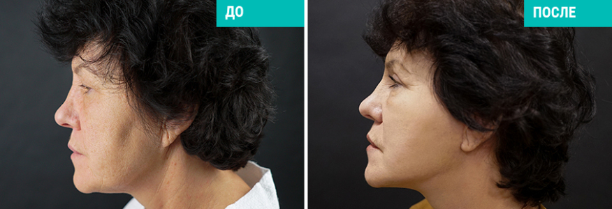 Фейслифтинг