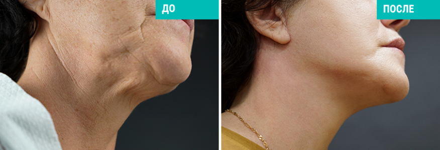 Фейслифтинг