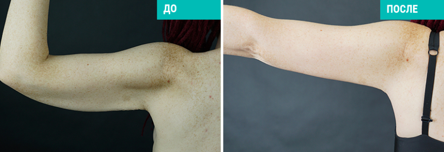 Абдоминопластика+брахиопластика