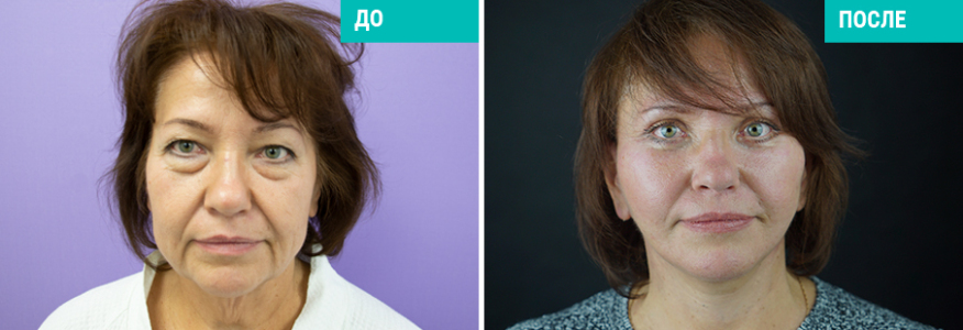 Фейслифтинг