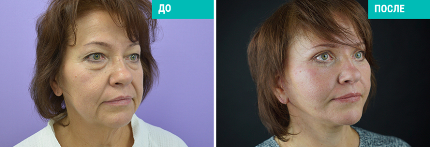 Фейслифтинг