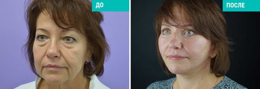 Фейслифтинг