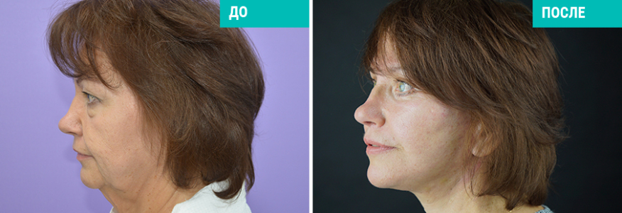 Фейслифтинг