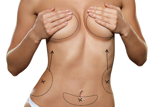 Липофилинг груди