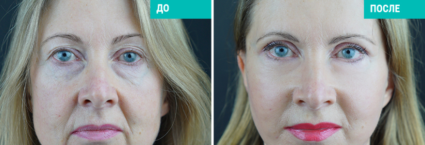 Фейслифтинг