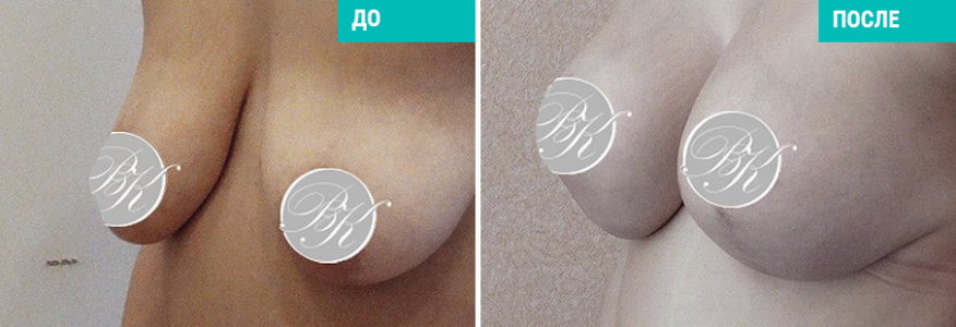 Увеличение груди