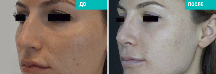 Ринопластика