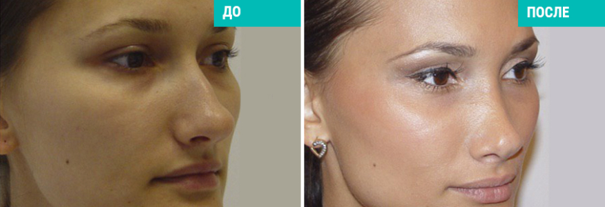 Ринопластика