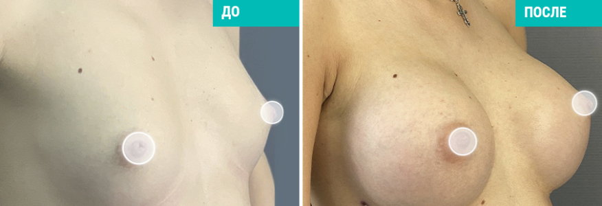 Увеличение груди