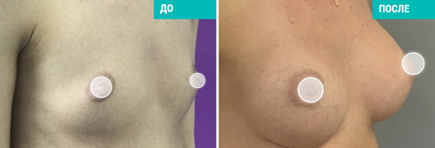 Увеличение груди