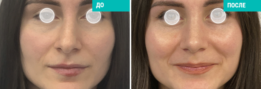 Ринопластика