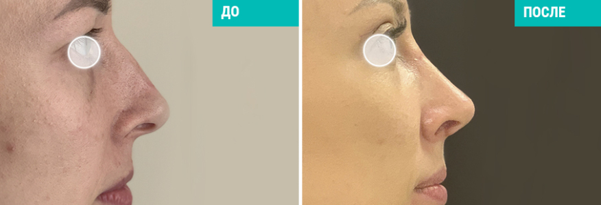 Ринопластика