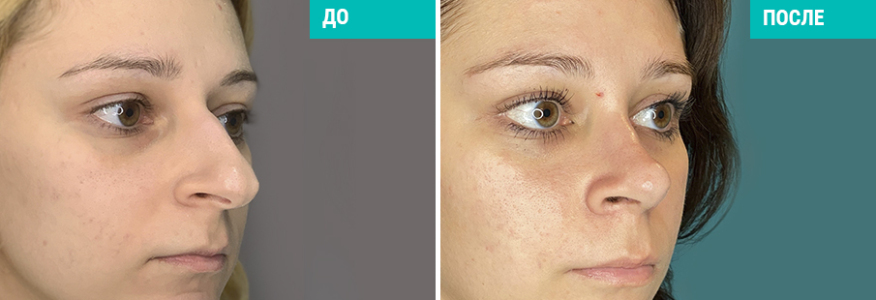 Ринопластика