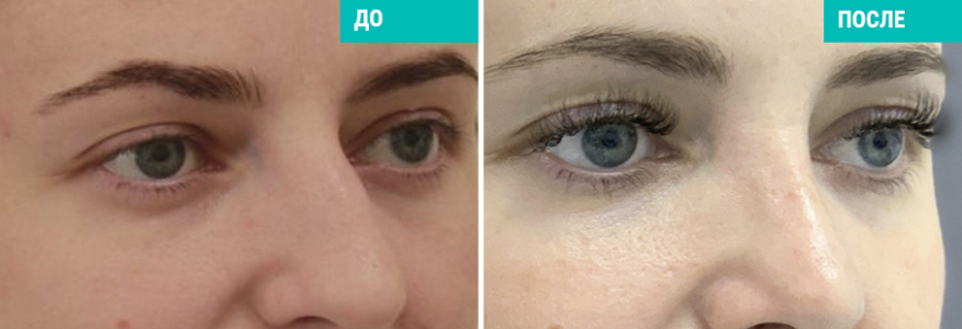 Ринопластика