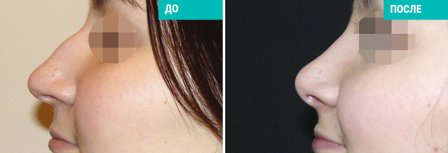 Ринопластика