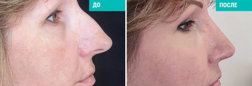 Ринопластика