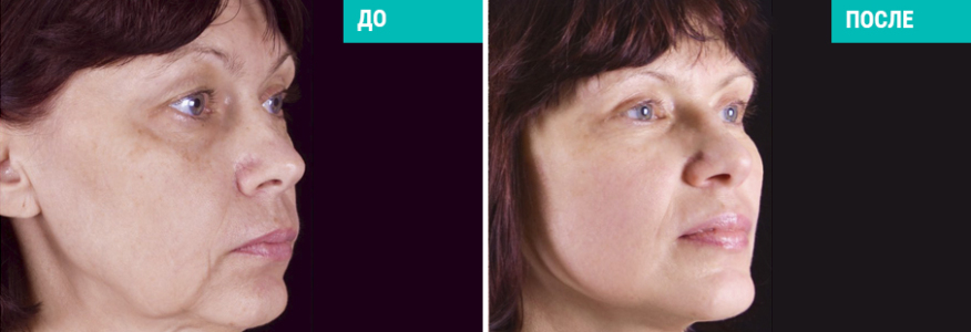 Тотальное омоложение лица