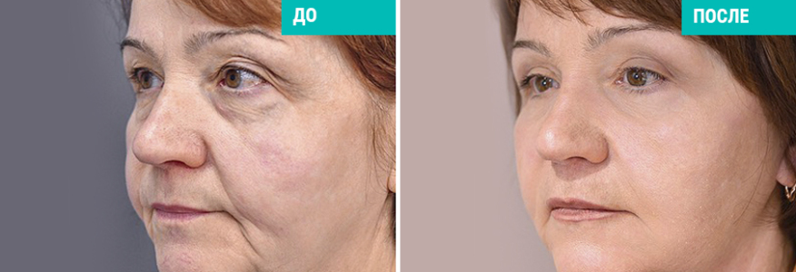 SMAS подтяжка лица и шеи+ круговая блефаро 