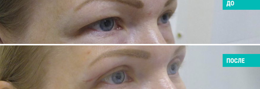 Блефаропластика