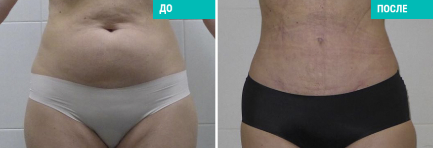 Липосакция