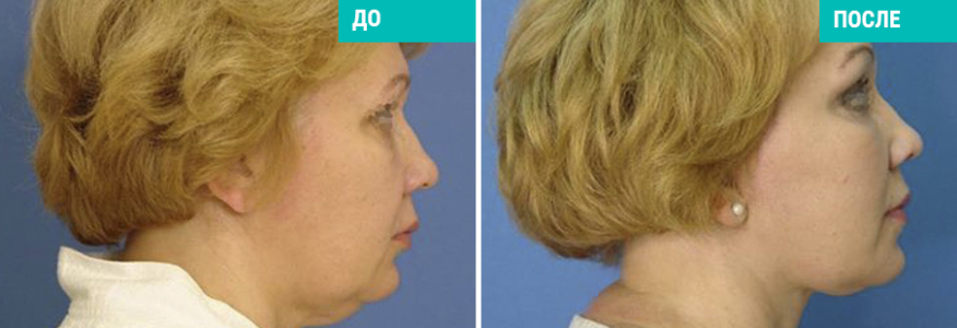 Тотальный фейслифтинг