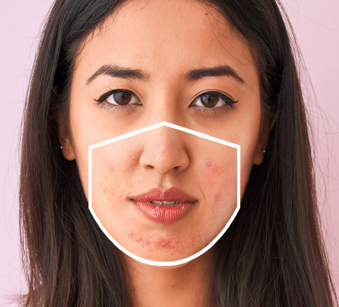 Акне от защитной маски: как его устранить?