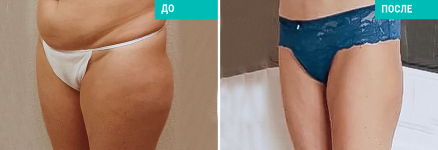 Липосакция