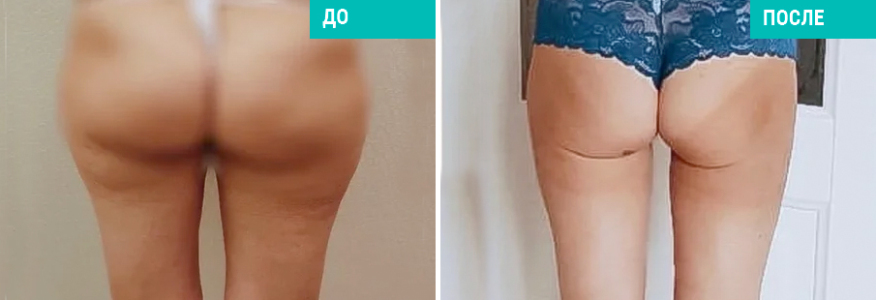 Липосакция