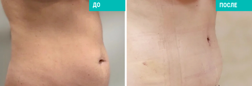 Липосакция