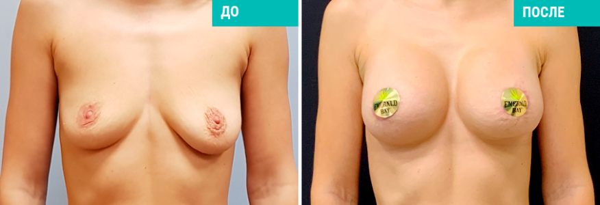 Увеличение груди