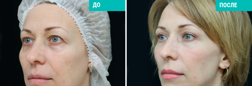 Подтяжка лица