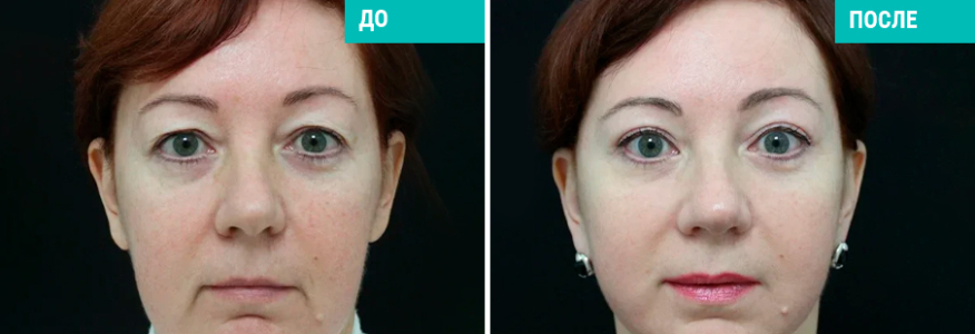 Подтяжка лица