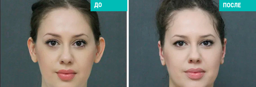 Отопластика