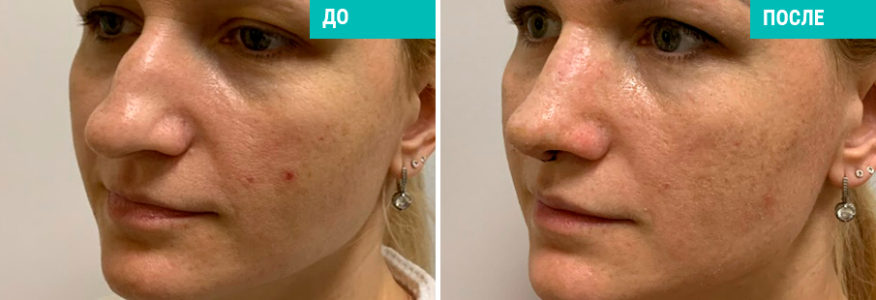 Ринопластика