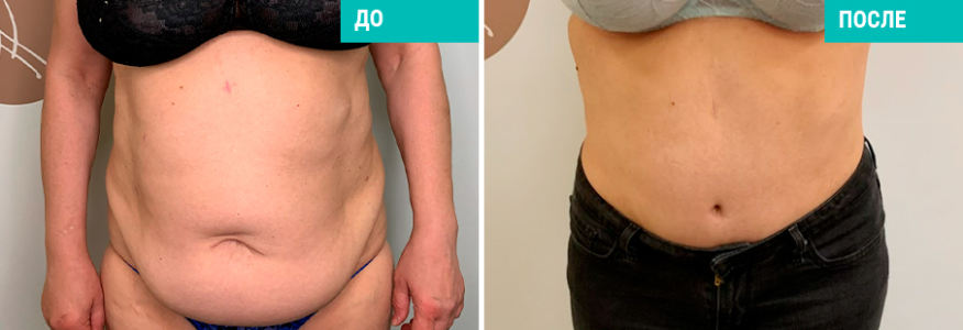 Абдоминопластика