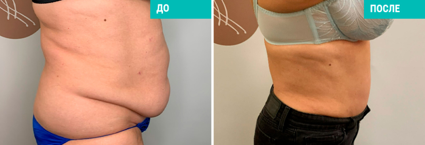 Абдоминопластика