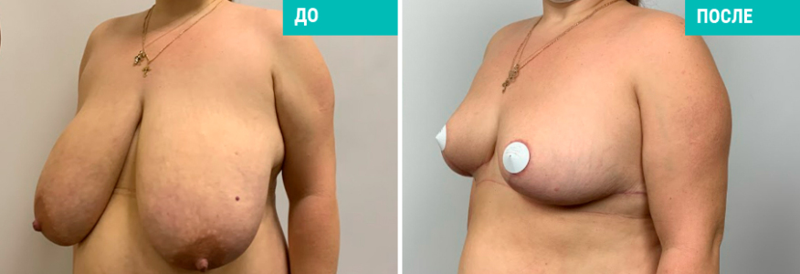 Маммопластика редукция