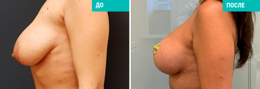 Маммопластика 