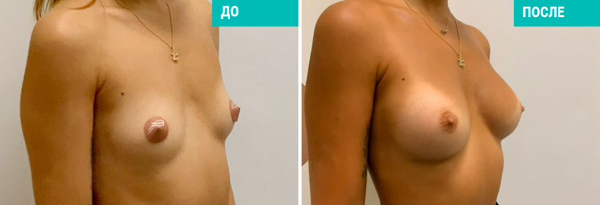 Маммопластика 