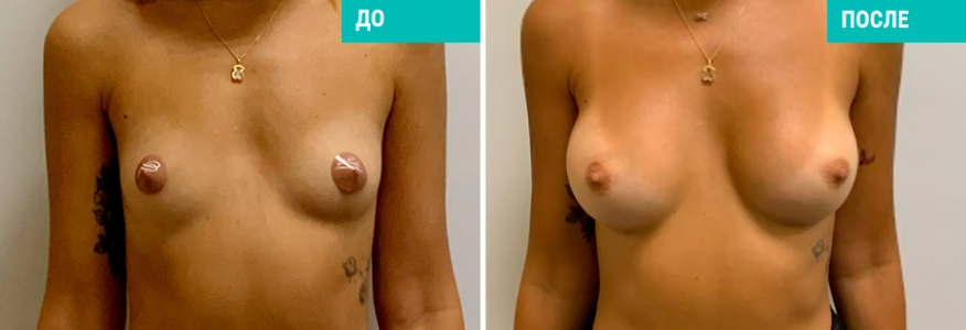 Маммопластика 